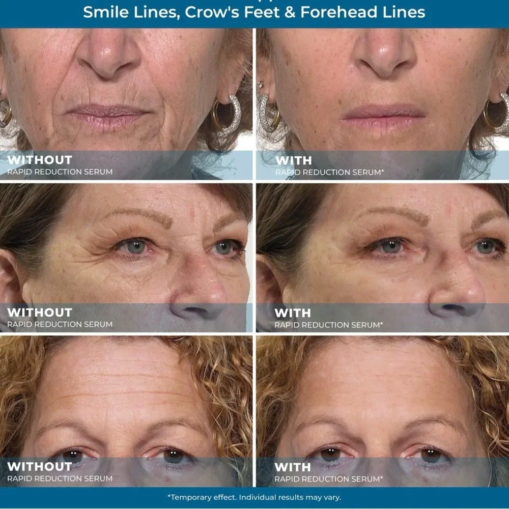 ONE TUBE Plexaderm Rapid Reduction Serum 0.33 oz - Picture 3 of 4